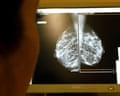 A person looking at a mammogram scan