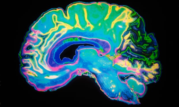 Blind children can repurpose brain's visual center to process speech Blind children can repurpose brain's visual center to process speech