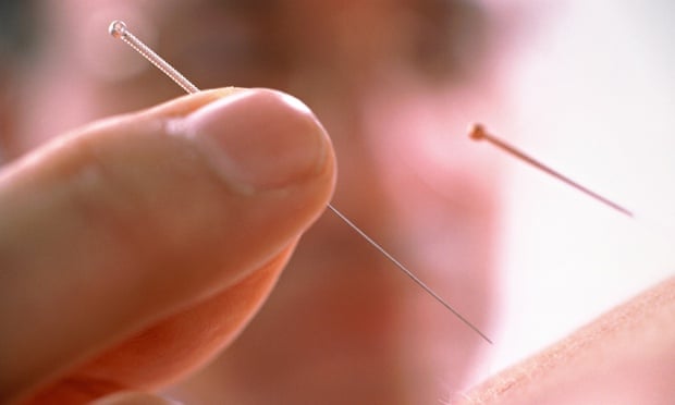  acupuncture needle 