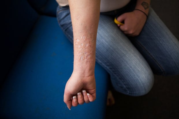 Kristin, a sex trafficking survivor, shows arm scars from her trafficking days. She has applied for a Survivors Ink scholarship to have the scars covered up with a tattoo. The scholarship has been granted and when the funds are raised she'll have her them covered.