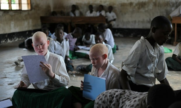 tanzania albinos