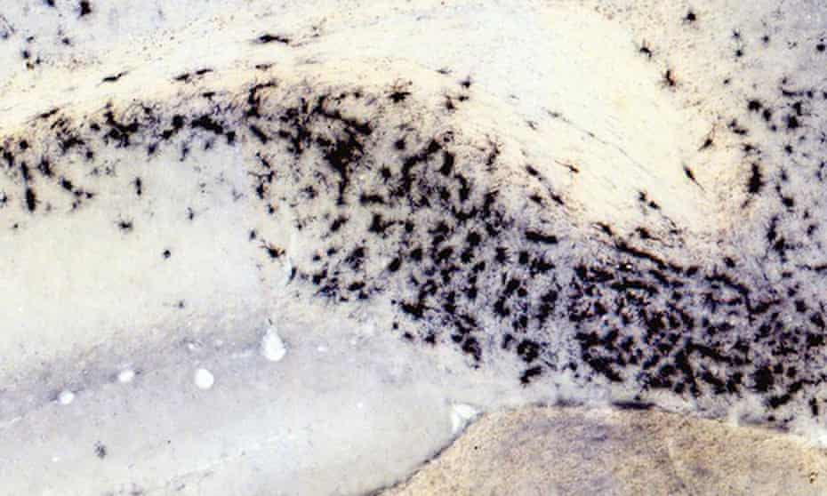 The dots in the picture are immune cells called microglia (highlighted with a black stain), which are more prevalent in brains affected by Alzheimer’s.