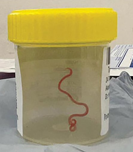 The roundworm specimen after being pulled out of the woman’s brain.