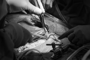 The process of stitching the recipient begins after many hours of surgery