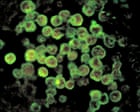 North Carolina teenager dies from rare infection caused by brain-eating amoeba