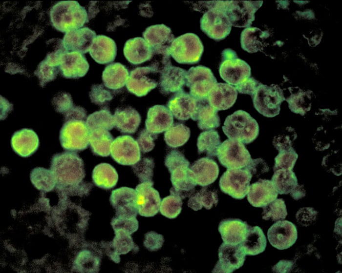 North Carolina teenager dies from rare infection caused by brain-eating amoeba