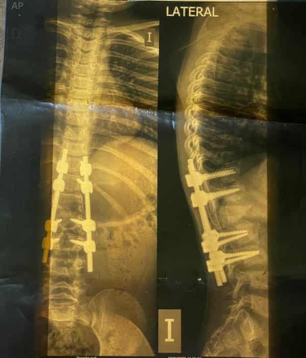 An X-ray image of a child’s spine found with migrants’ abandoned belongings at the US-Mexico border
