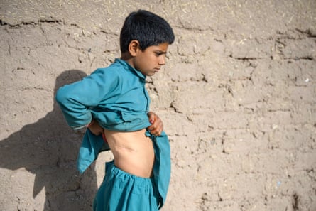 A boy lifts his shirt to show a scar on his torso.