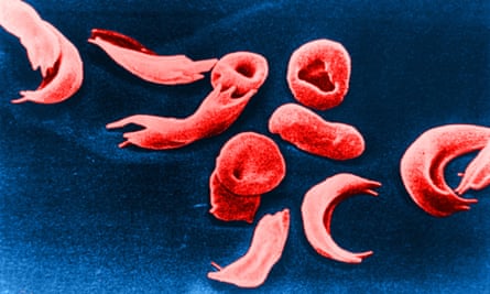 Red blood cells affected by a sickle cell disease viewed under a microscope against a dark blue background. 