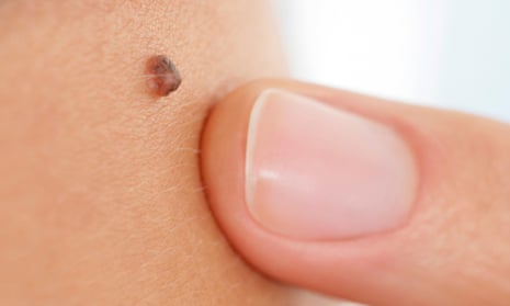 The new system could provide a low-cost way to check whether skin lesions are cause for concern.