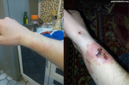 Stanislav Volkov’s arm after he was attacked with acid