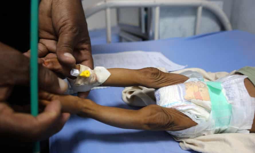 A malnourished Yemeni child receives treatment at a hospital in Hodeidah earlier this year.
