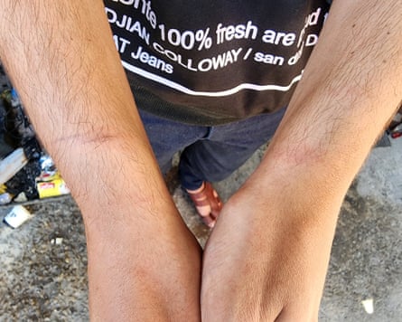 View of marks on the man’s wrists and lower arms.