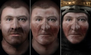 Reconstructed face of Robert the Bruce before leprosy (left) and after. 