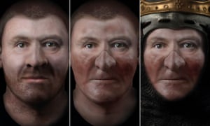 Reconstructed face of Robert the Bruce before leprosy (left) and after.