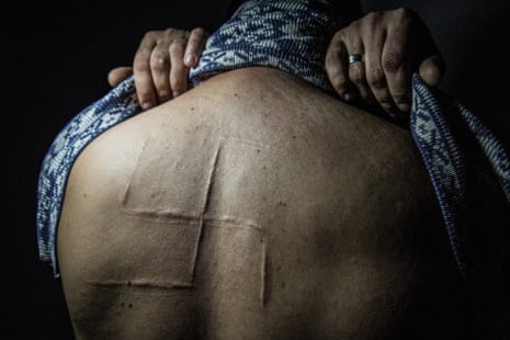 A man lifting his top to his neck to reveal a large swastika scar on his upper back