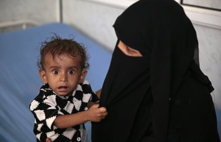 A woman holds her malnourished boy at a feeding centre in a hospital in Hodeidah