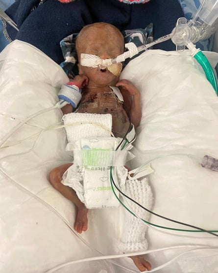 A very small baby connected to hospital equipment