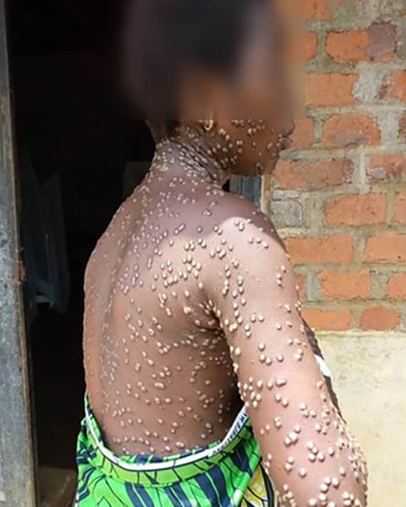 A young African woman with her face, neck, arms and torso covered by small fluid-filled blisters