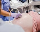 PFAS Linked to Child Gut Inflammation After Early Exposure