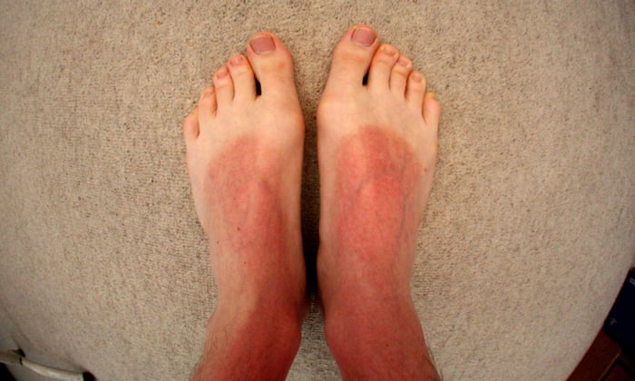 A Tale Of Two Sunburns Sunblock Is For Everyone Lanre Bakare And Megan Carpentier The Guardian A Tale Of Two Sunburns Sunblock Is For Everyone Lanre Bakare And Megan Carpentier The Guardian
