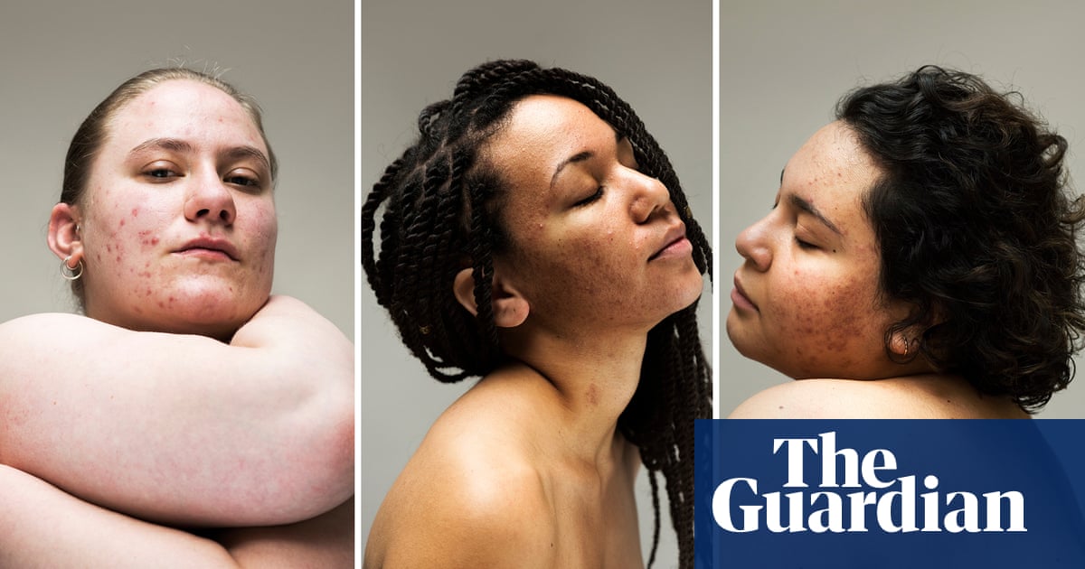 Behind the makeup: women defy the stigma of ‘imperfect’ skin – in pictures