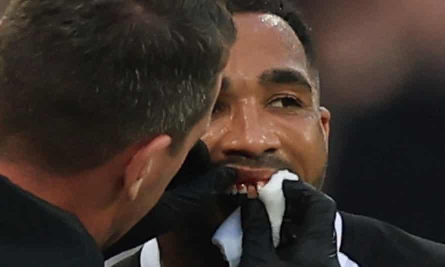 Newcastle United's Callum Wilson receives medical attention after damaging a tooth.