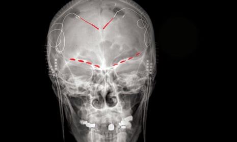 A frontal X-ray of one of the study’s participants, showing (red) implanted brain electrodes connected to recording implants on each side.