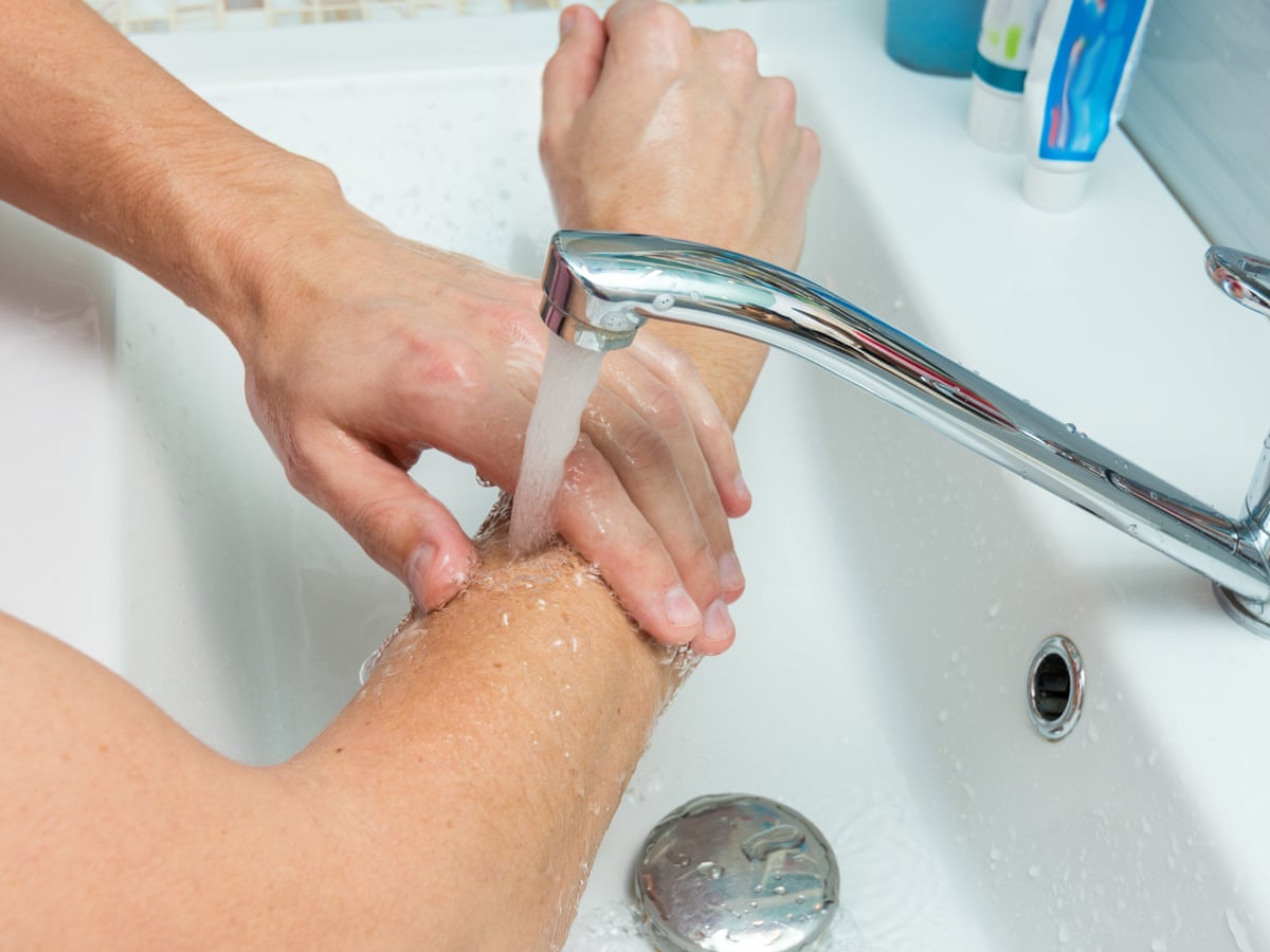 How to treat a minor burn | Health & wellbeing | The Guardian