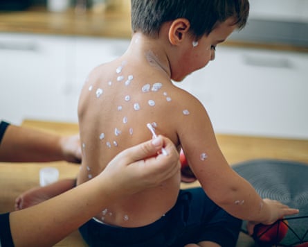 A mother taking care of her son with chicken pox.