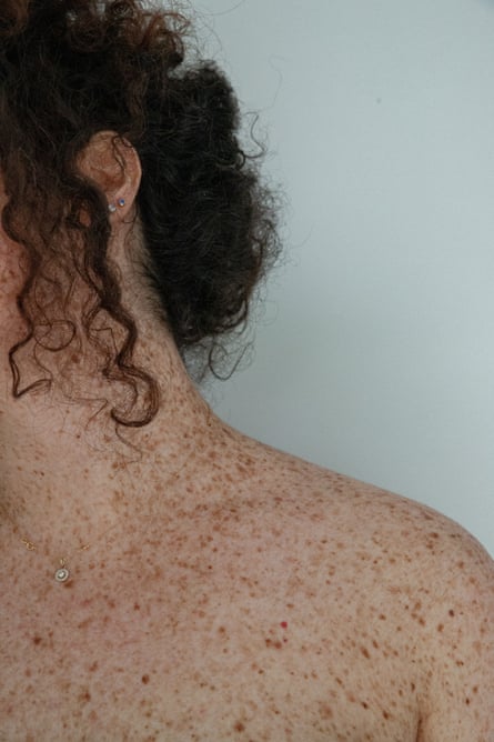 Nihal’s skin, which is covered in freckles