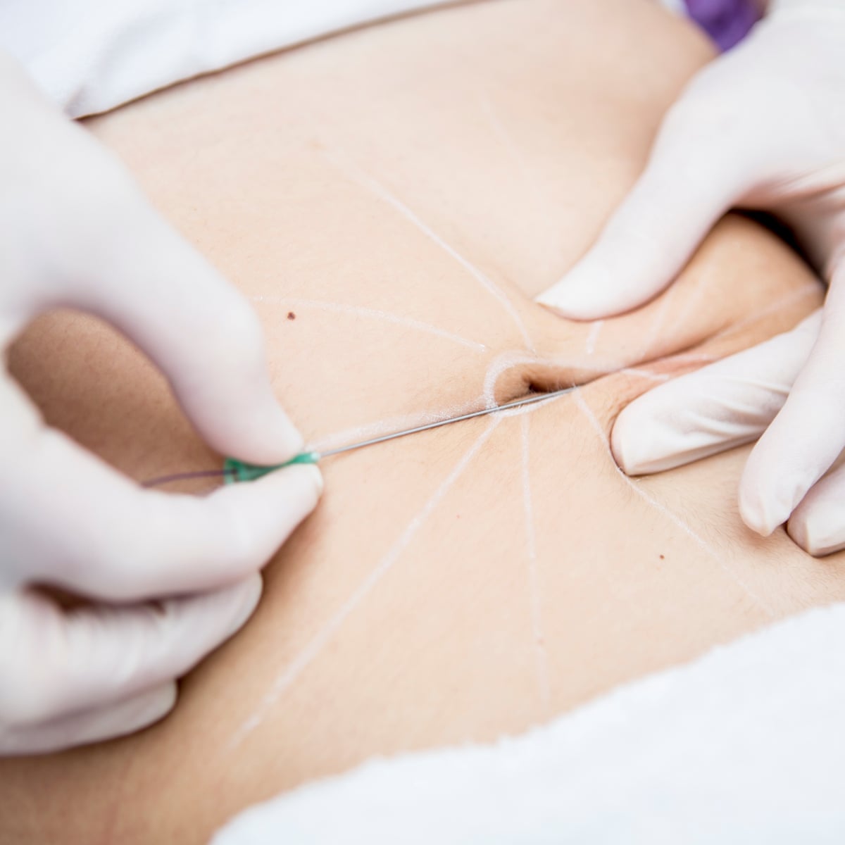 Outies out, innies in: the vogue for belly button reshaping surgery | Cosmetic surgery | The Guardian Outies out, innies in: the vogue for belly button reshaping surgery | Cosmetic surgery | The Guardian