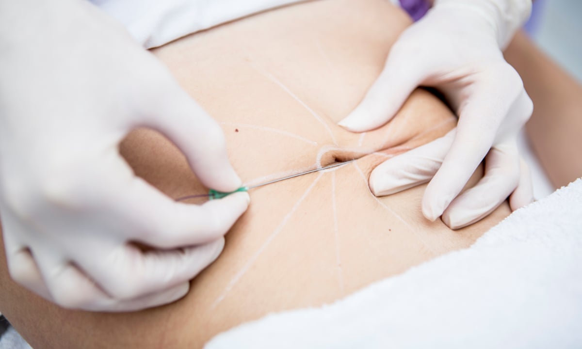 Outies out, innies in: the vogue for belly button reshaping surgery | Cosmetic surgery | The Guardian Outies out, innies in: the vogue for belly button reshaping surgery | Cosmetic surgery | The Guardian