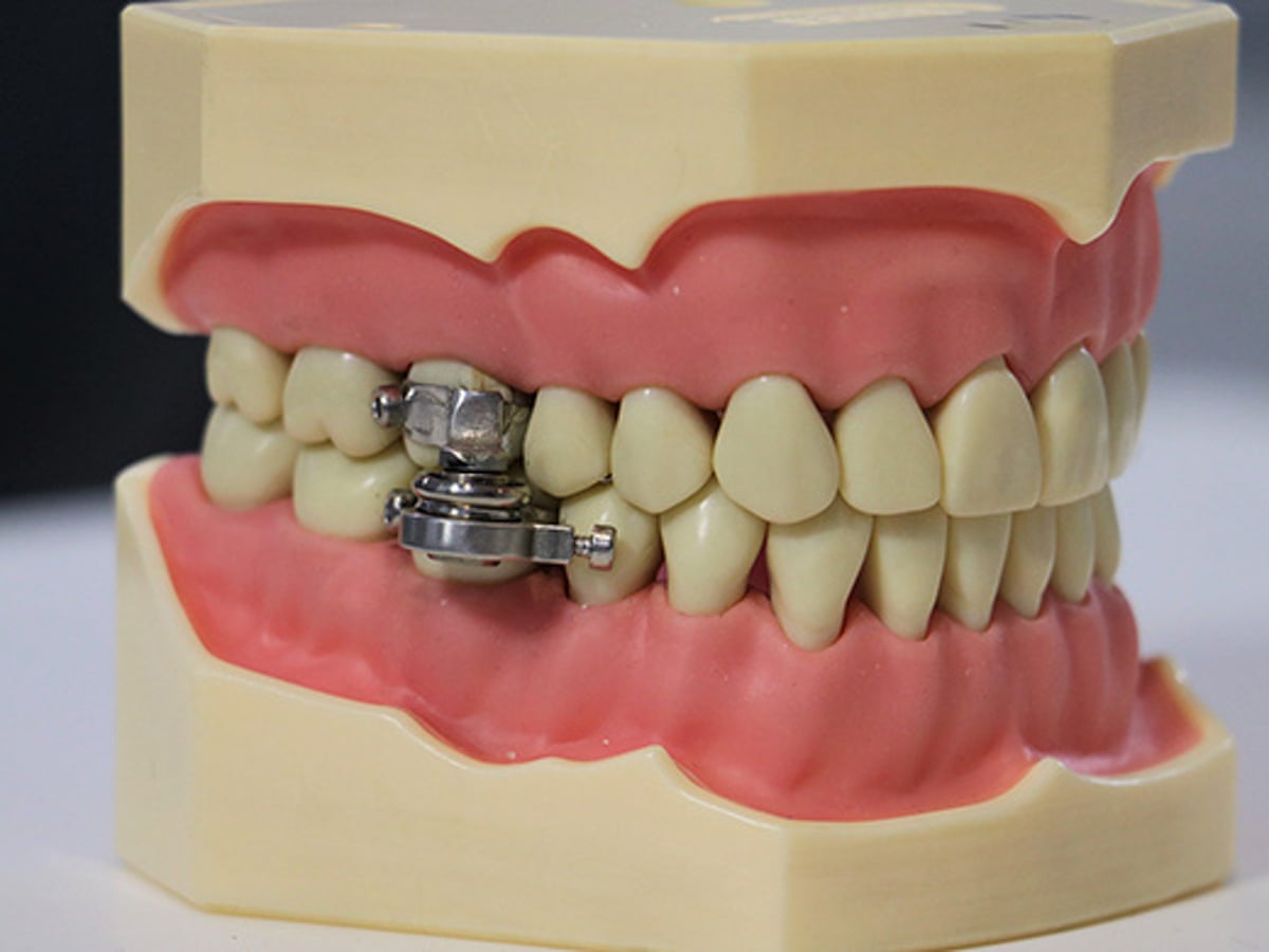New Weight Loss Tool Prevents Mouth From Opening More Than 2mm Diets And Dieting The Guardian New Weight Loss Tool Prevents Mouth From Opening More Than 2mm Diets And Dieting The Guardian