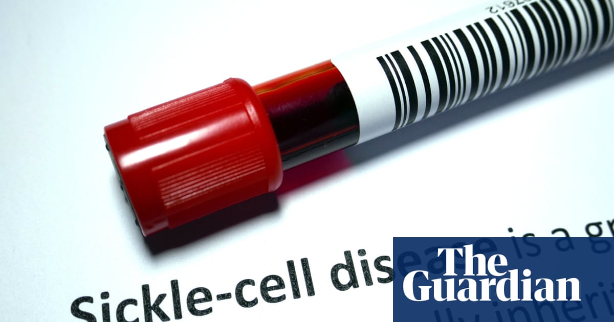NHS England to offer breakthrough treatment for sickle cell disease