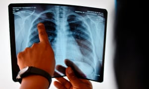 TB kills more people every year than any other infectious disease, including Aids, says the report - an estimated 1.8 million people in 2015.