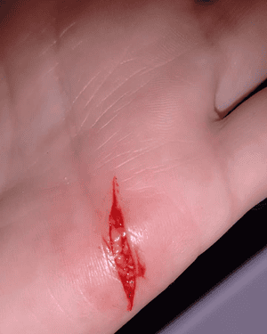 finger cut injuries palm vegetable open wound peeled coconut fruit readers instead related their