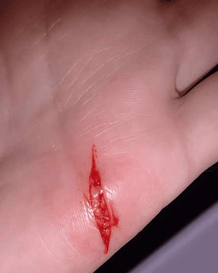 Medium open cut wound on left palm.