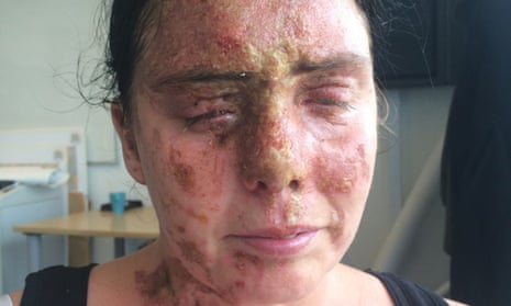 Carla Whitlock, 37, suffered serious burns after being attacked with acid