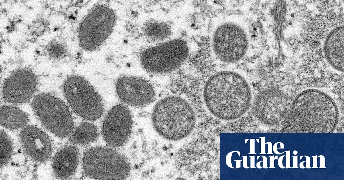 UK records 77 more cases of monkeypox, taking total to 302