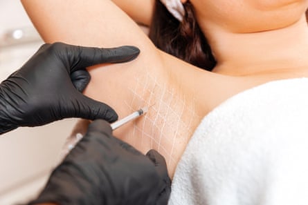 Close up of a woman's armpit with with white drawn lines against which a cosmetologist in black latex gloves is injecting botox. Photo shows part of woman's face and hair and a white towel