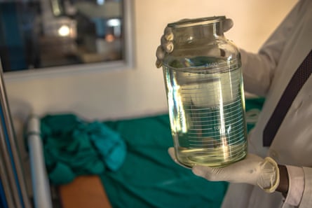 A pair of hands wearing latex gloves hold a 2.5 litre surgical jar full of slightly yellowish liquid.