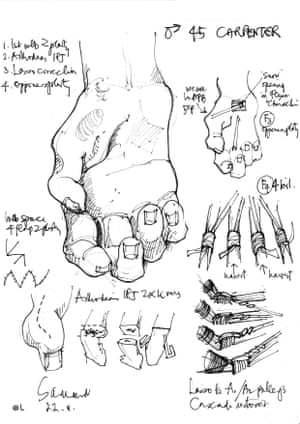 Surgery notes for a 45-year-old male carpenter needing Lasso correction and opponensplasty. Drawing by Donald Sammut, Working Hands charity.