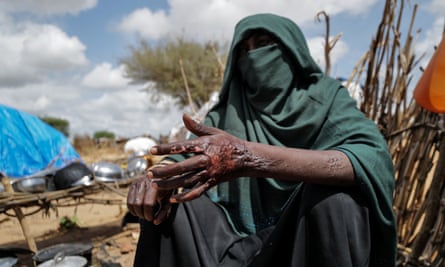 A Sudanese activist in Chad who fled Darfur shows her burn scars she says she got during an attack by the RSF on the camp where she lived