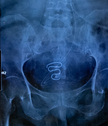 An X-ray, tinted blue, clearly showing a coil of metal in the pelvic area