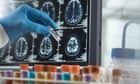 Thousands to be offered blood tests for dementia in UK trial
