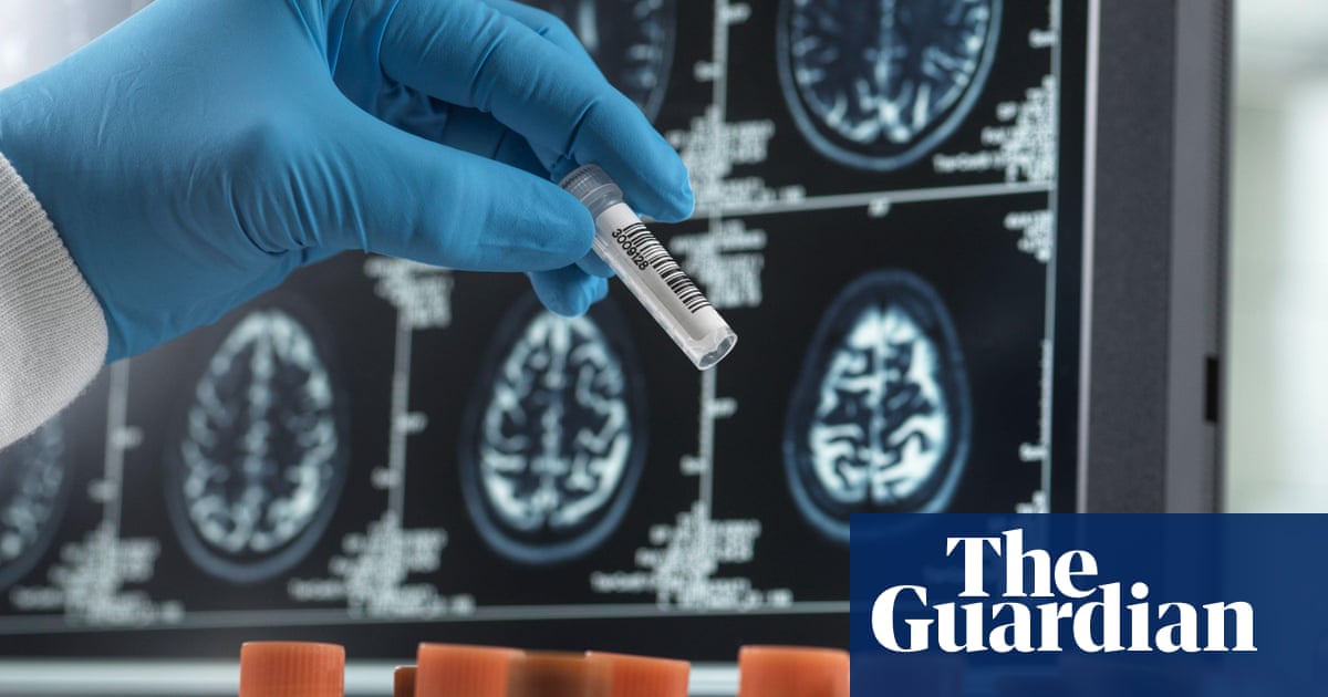 Alzheimer's blood test can spot people with early symptoms, study suggests
