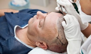 A hair transplant operation.