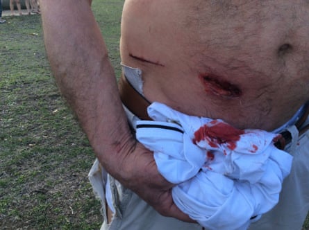 A German tourist reveals his injuries after being attacked by a kangaroo outside Morisset hospital