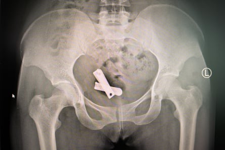 An X-ray image showing a nail clipper inserted inside a uterus.